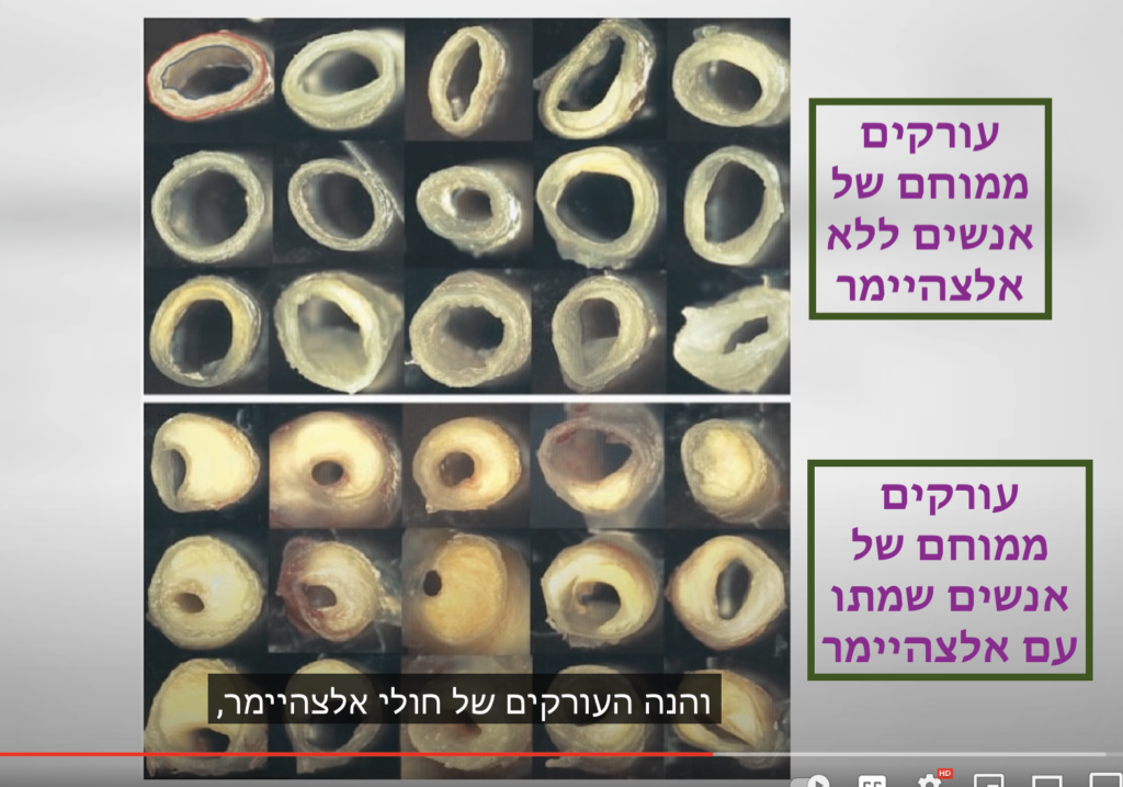 טרשת עורקים דמנציה אלצהיימר